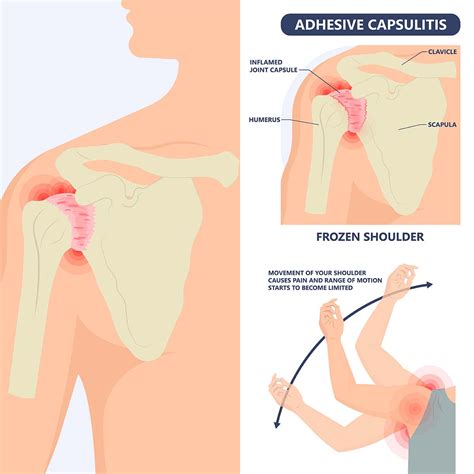 Frozen Shoulder Causes