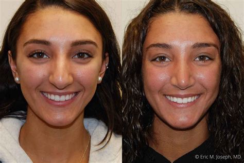 When Can I Sleep Flat After Septoplasty at Lori Manfredi blog