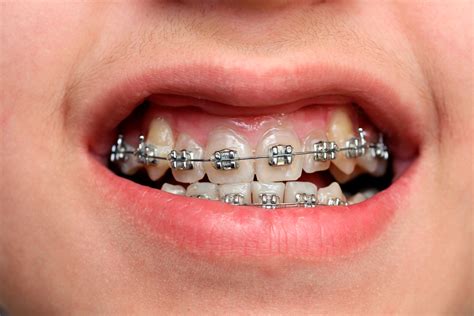Orthodontic Bands: Advantages and Disadvantages | Orthodontics, Metal braces, Dentist