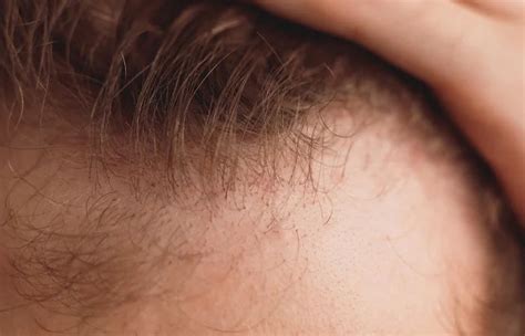Pimples On Scalp: Causes & How to Get Rid of Them | ThriveCo