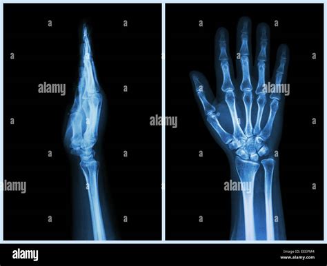 X Ray Normal Hand High Resolution Stock Photography and Images - Alamy