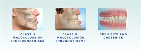 Understanding the Differences Between Skeletal Malocclusion and Dental ...