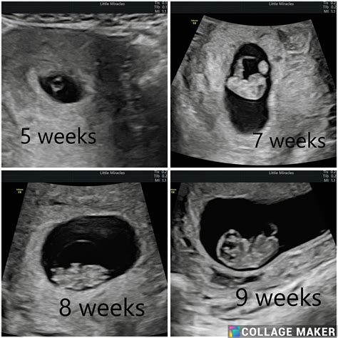 What to expect at an early scan.