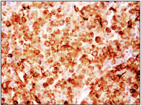 Mast Cell Leukemia: An Update with a Practical Review
