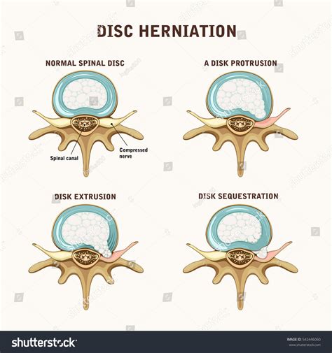Image result for Foraminal Disc Extrusion
