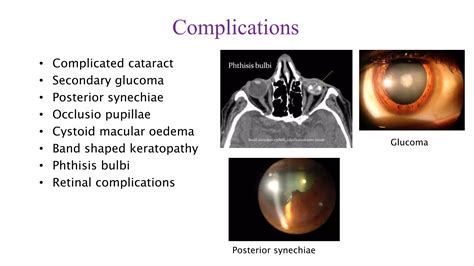Disorders of uveal tract | PPTX