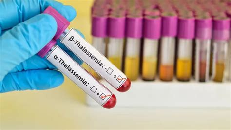 Are You A Thalassemia Minor? Doctor Explains How Thalassemia Trait Can ...