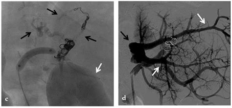 The Role of Imaging in Portal Vein Thrombosis: From the Diagnosis to the Interventional ...