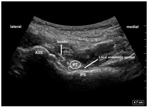 Pericapsular Nerve Group (PENG) Block versus Supra-Inguinal Fascia ...
