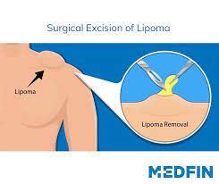 Medfin BlogHow to Treat Lipomas - Medfin Blog