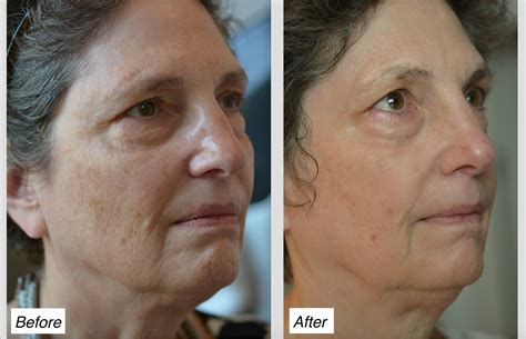 Laser Skin Resurfacing | Charleston | Charleston Facial Plastic Surgery