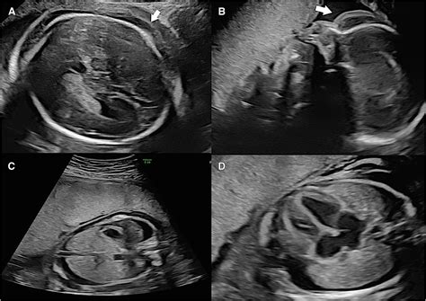 Hyperreactio luteinalis associated with nonimmune fetal hydrops ...