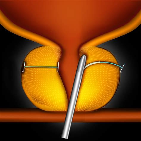 Prostate UroLift System - Minimally Invasive BPH Treatment