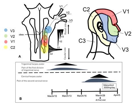 Neurology International | Free Full-Text | Trigeminal Herpes Zoster ...