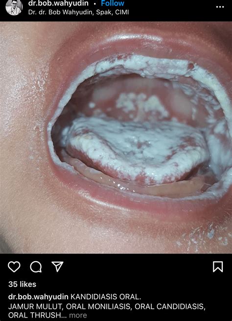 Thrush In Babies Roof Of Mouth