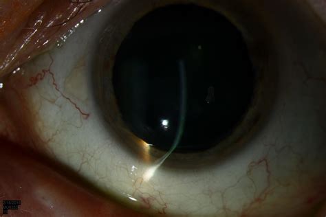 Atlas Entry - Pellucid marginal degeneration