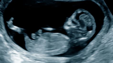 12 Week Ultrasound