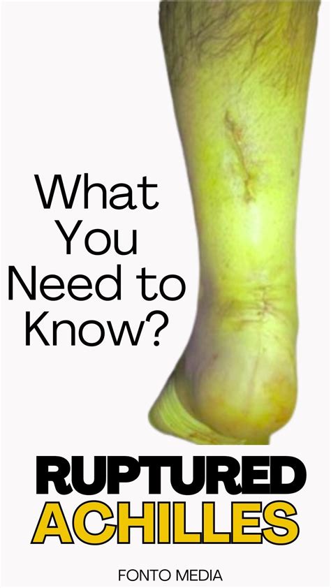 Achilles tendon ruptures – Artofit