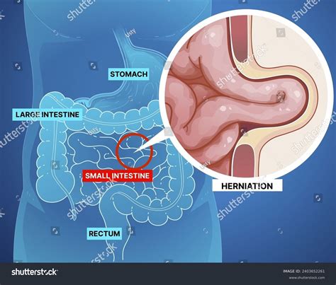 415 Hernia Problems Stock Vectors and Vector Art | Shutterstock