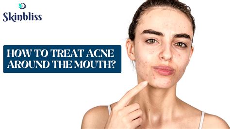 How To Treat Acne Around the Mouth? - Skin Bliss Clinic, Hyderabad