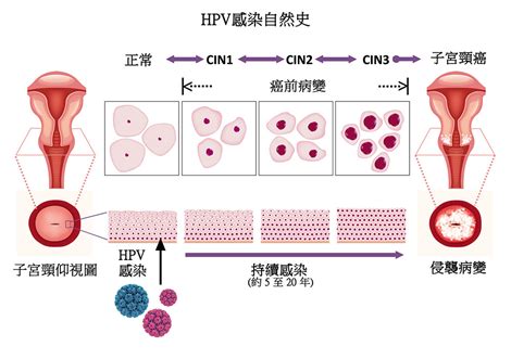 科学网—体检发现HPV阳性，怎么办？海豚博士答读者问 - 张艳梅的博文