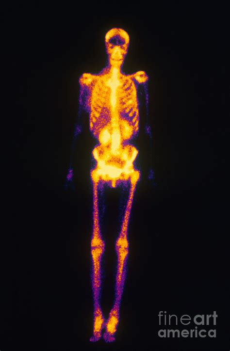 Image result for Normal Bone Scan