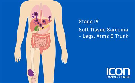What is Soft Tissue Sarcoma? | Icon Oncology Malaysia