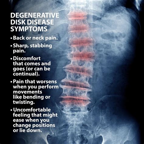 What are the symptoms of degenerative disc disease? | Orthopaedics Toronto - OrthoTO