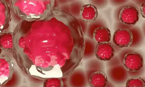 Malaria drug could combat chemotherapy-resistant head and neck cancers