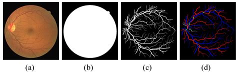 End-to-End Automatic Classification of Retinal Vessel Based on ...