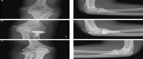 Prosthetic Radial Head 的图像结果