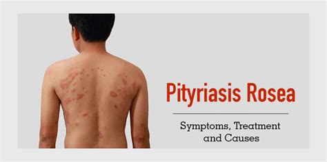 Image result for Rash Algorithm Pityriasis