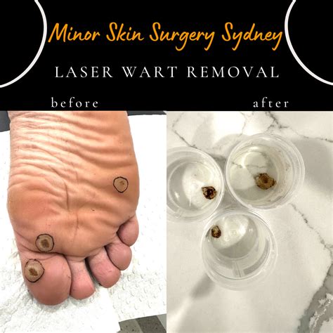 Plantar Warts Laser Treatment Cost at Charles Dunaway blog