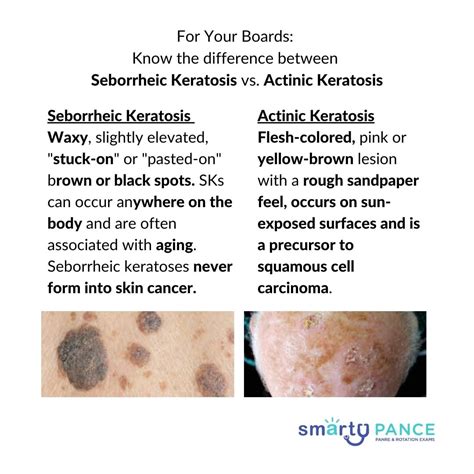 How Can You Tell The Difference Between Seborrheic Keratosielanoma - Infoupdate.org