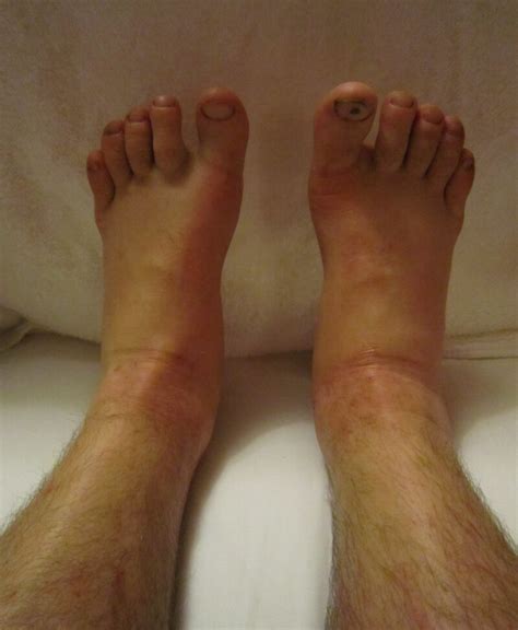 Benign Causes of Both Ankles Being Swollen & Puffy and Treatment ...