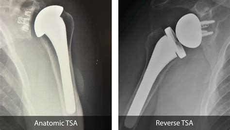 Reverse Shoulder Replacement - Dr. Chris Jones Colorado Springs, CO