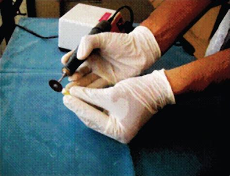 Image result for Pulp Extraction Tooth