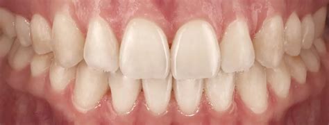 Treatment of Open Bite Concerns | Spark Clear Aligners