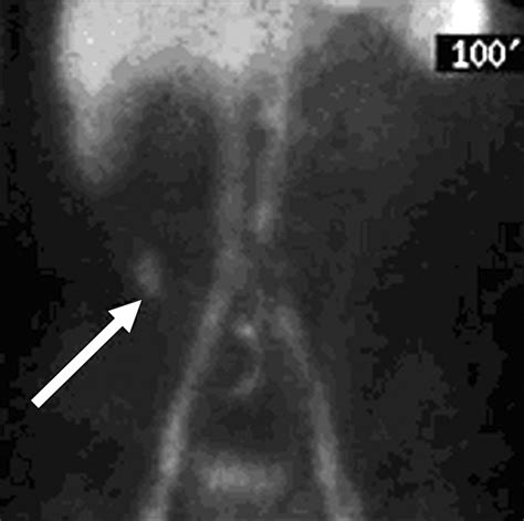 Imaging Manifestations of Meckel's Diverticulum | AJR