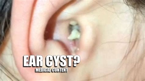 Image result for Exploding Pimples