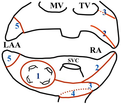 Long-Term Results of the Mini Maze Standalone Bi-Atrial Surgical ...