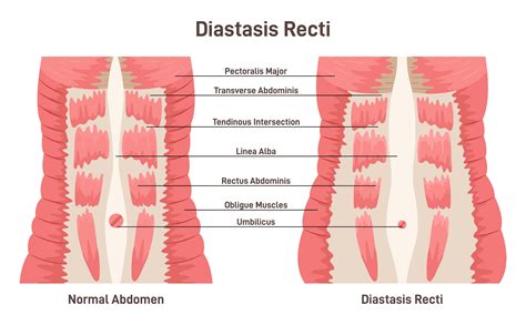 Abdominal Muscles Separation (Diastasis Recti)