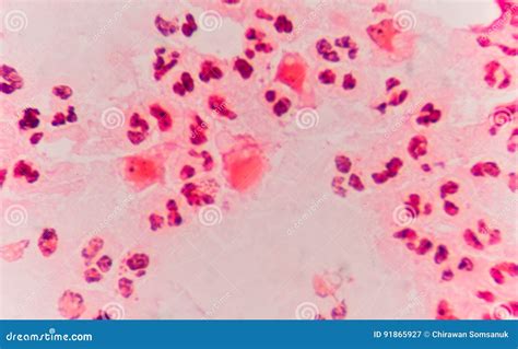 Moderate Red White Blood Cells with Gram Negative Diplococci. Stock ...