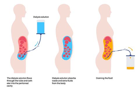 Image result for Dialysis Procedure Step by Step