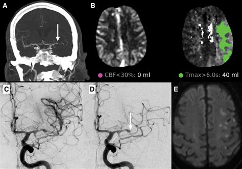 Large Vessel Occlusion Stroke due to Intracranial Atherosclerotic ...