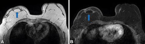 Nipple-sparing Mastectomy: What the Radiologist Should KnowRadioGraphics