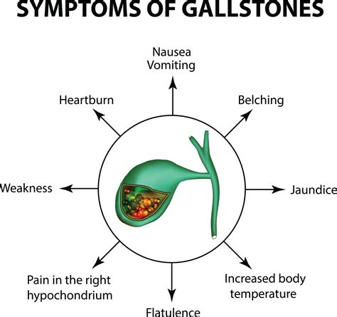 Gallstones | Christina Ong- Paediatric & Gastroenterology Clinic