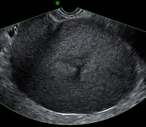 Ovarian Cancer Tumor Ultrasound