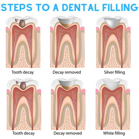 What Are Fillings For Teeth