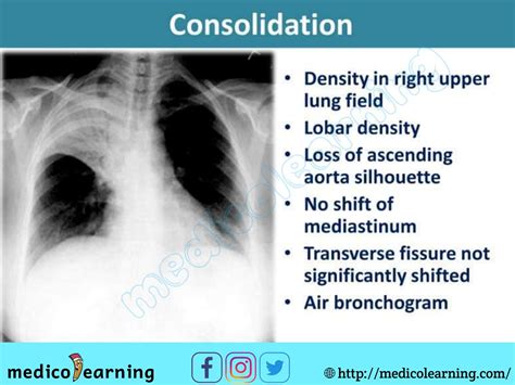 Local pleural effusion – Artofit